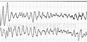 fibrilacion ventricular, corprotegit