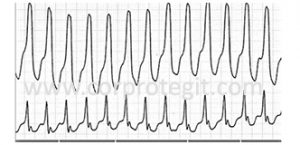 Taquicardia ventricular, corprotegit